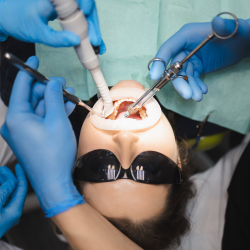 Dental Fillings
