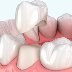 Dental Crown