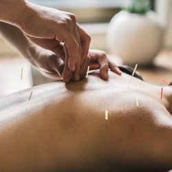 Acupuncture