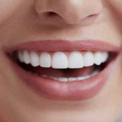 White Blitz LED Teeth Whitening