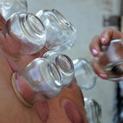 Cupping Therapy