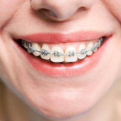 Braces
