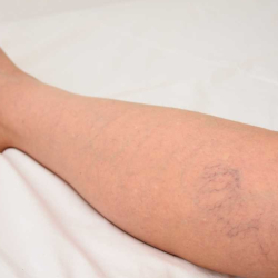 Sclerotherapy