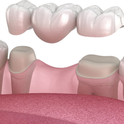 Missing Teeth