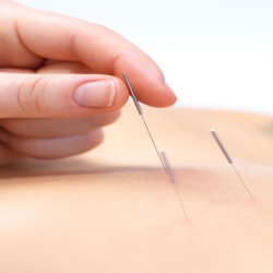 Acupunture