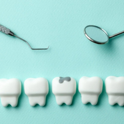 Dental Fillings
