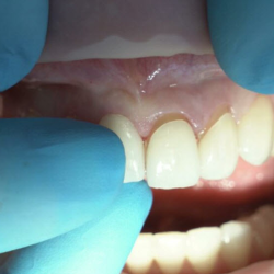 Dental Veneers