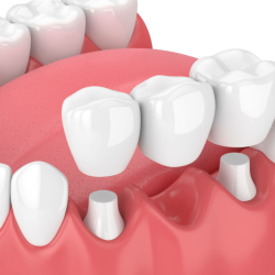 Dental Bridges