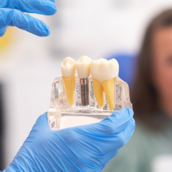 Dental Implants