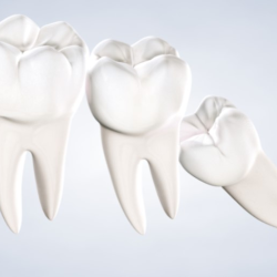 Wisdom Teeth Removal