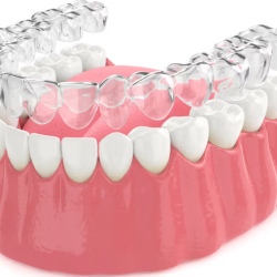 Clear Aligners