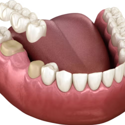 Dental Bridges