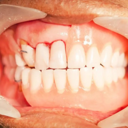 Periodontal Treatment (Gum Treatment)