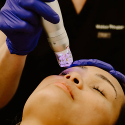 Scarlet SRF Microneedling