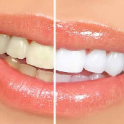 Whitening