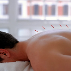 Dry Needling