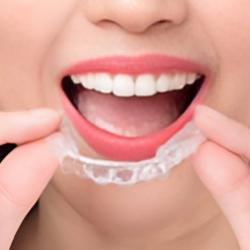 Invisalign