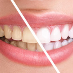 Teeth Whitening