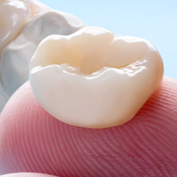 Dental Crowns