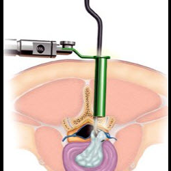Minimally Invasive Spine Surgery