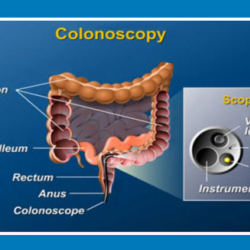 Colonoscopy
