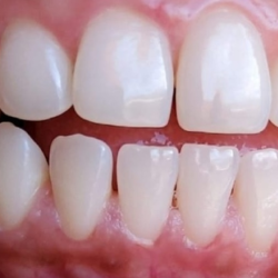 Teeth Whitening