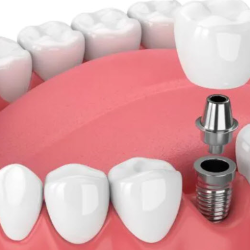 Dental Implants