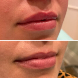 Botox + Juvederm