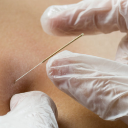 Functional Dry Needling