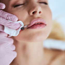 Lip Augmentation
