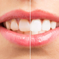 Whitening
