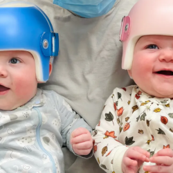 Plagiocephaly