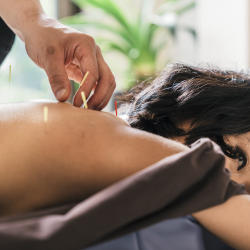 Acupuncture