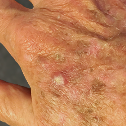 Actinic Keratosis