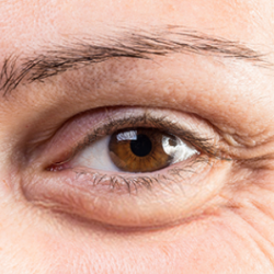 Crows Feet