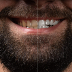 Teeth Whitening
