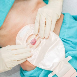Ostomy