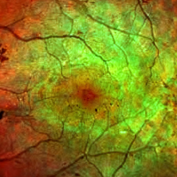 Diabetic Retinopathy