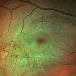 Retinal Vein Occlusion