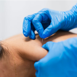 Dry Needling