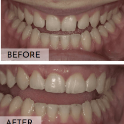 Composite Fillings