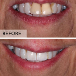 Same-Day Crowns and Bridges