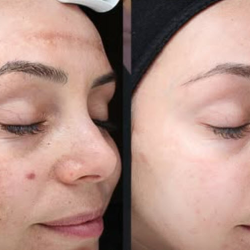 Chemical Peel (VI Peel)