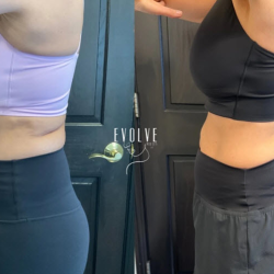 EvolveX Body Contouring