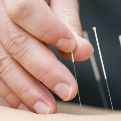 Acupuncture
