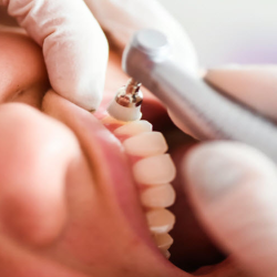 Restorative Treatment