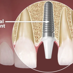 Dental Implants