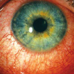 Diagnosis and Treatment of Ocular Infections and Injury