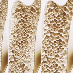 Natural Osteoporosis and Menopause