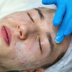 Chemical Peels